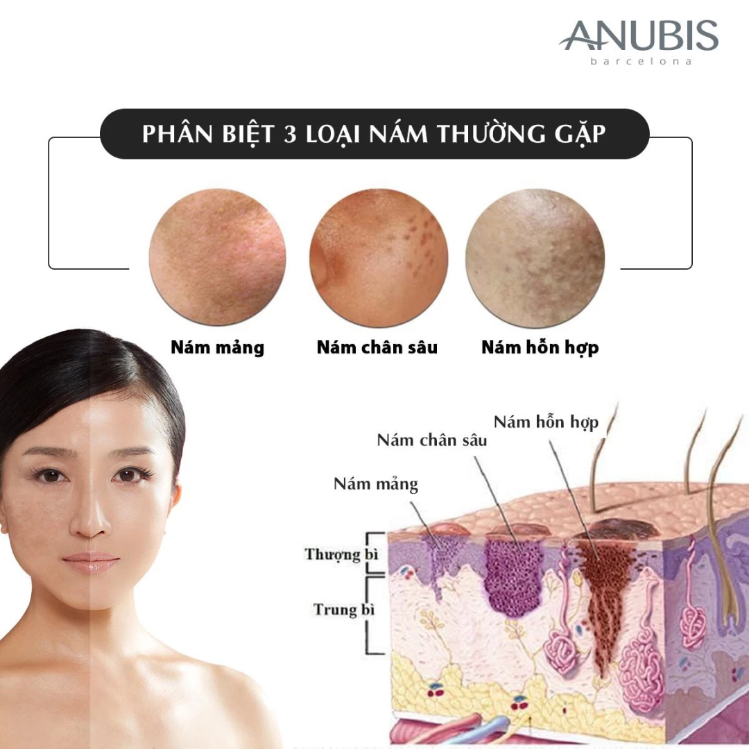 Phân biệt các loại nám thường gặp