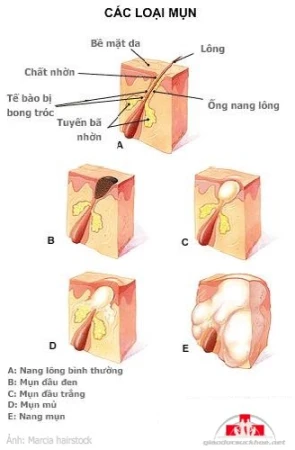 Da mụn