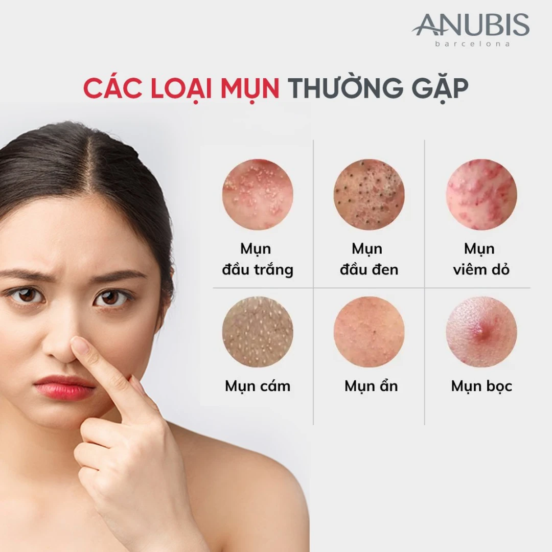 Các loại mụn thường gặp